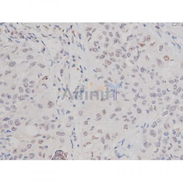 Phospho-Tau (Thr181)[Thr498] Antibody - AF3149 at 1/200 staining Human lung cancer tissue sections by IHC-P.